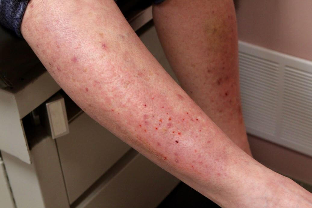 bites-itchiness-dermatitis-herpetiformis-skin-rash-woman-Nonceliac-Gluten-Sensitivity-owl-pest-control